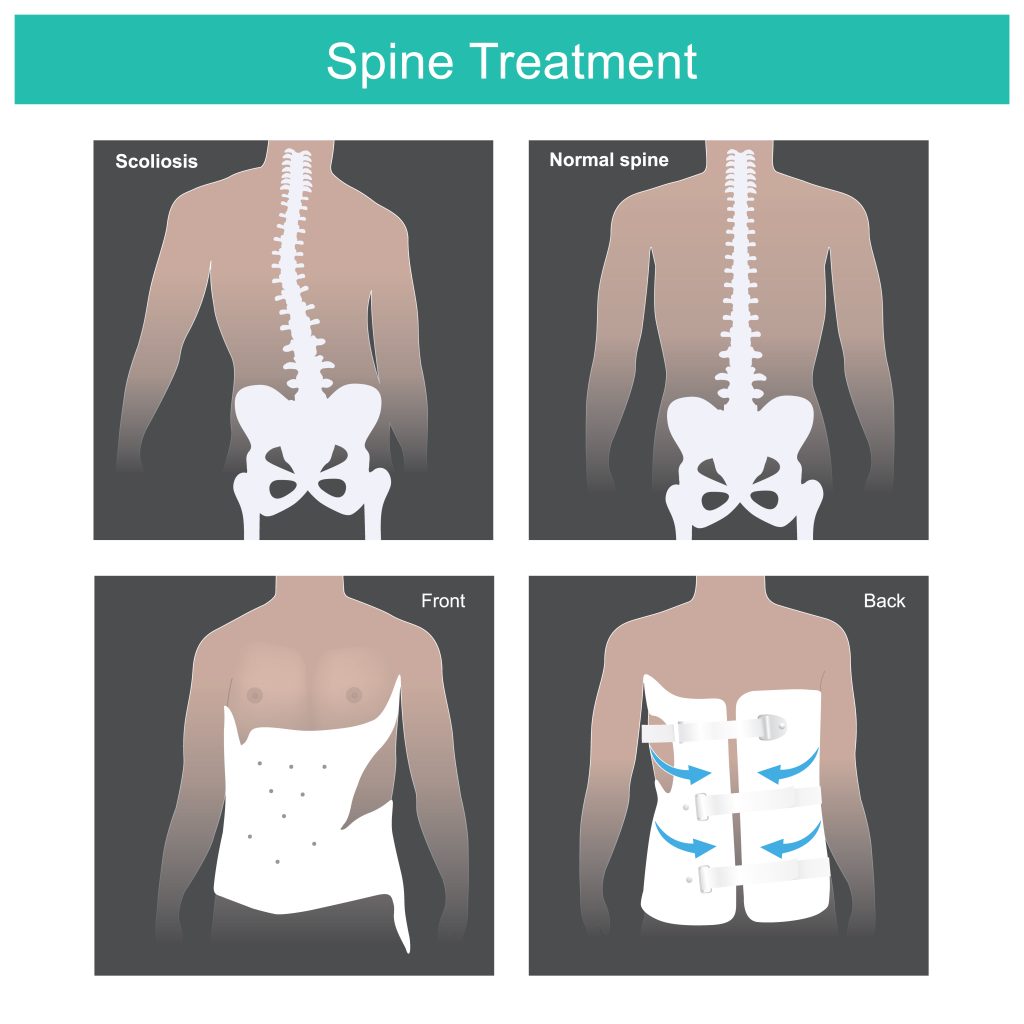 Chiropractic treatment for scoliosis