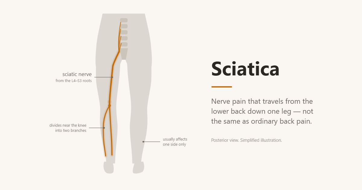 Diagram of the sciatic nerve running from the L4 to S3 nerve roots down the back of one leg, dividing into two branches near the knee.