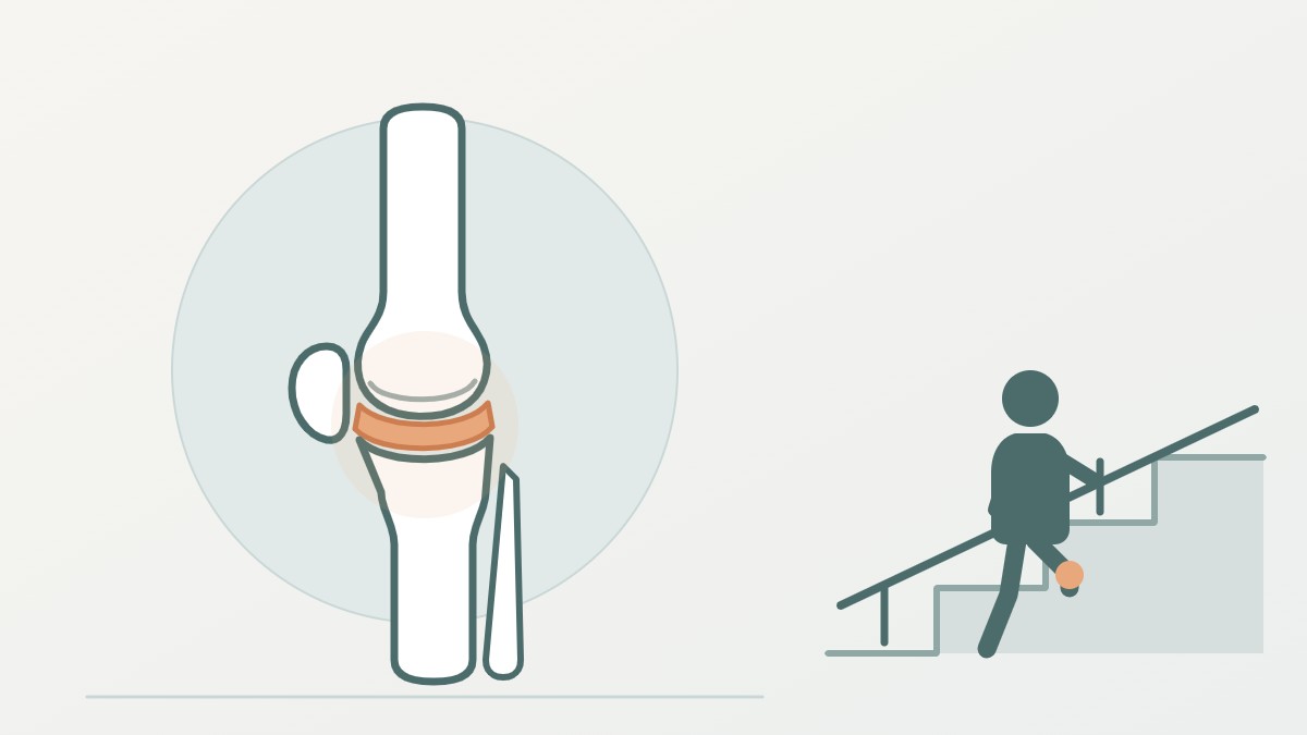 Diagram of a knee joint showing thinning cartilage between the thigh bone and shin bone, beside an older adult climbing stairs while holding the handrail